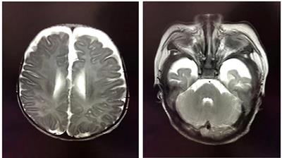 Case report: A novel PPP3CA truncating mutation within the regulatory domain causes severe developmental and epileptic encephalopathy in a Chinese patient